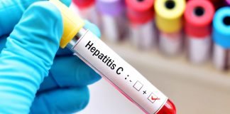 U Srbiji ima 80.000 inficiranih virusom hepatitisa C