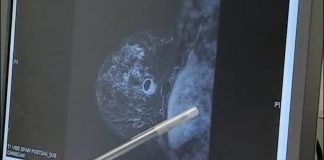 Besplatno snimanje pokretnim mamografom u Vojvodini